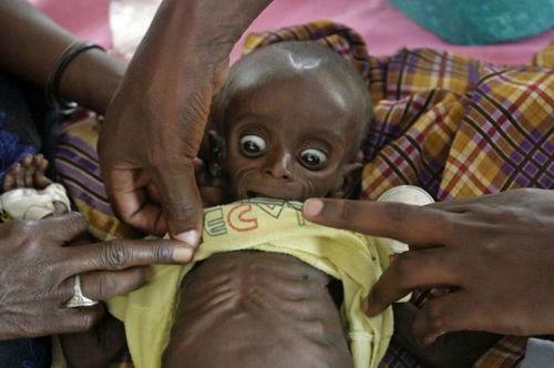 皮包骨头图片,揭示营养不良的严峻现实